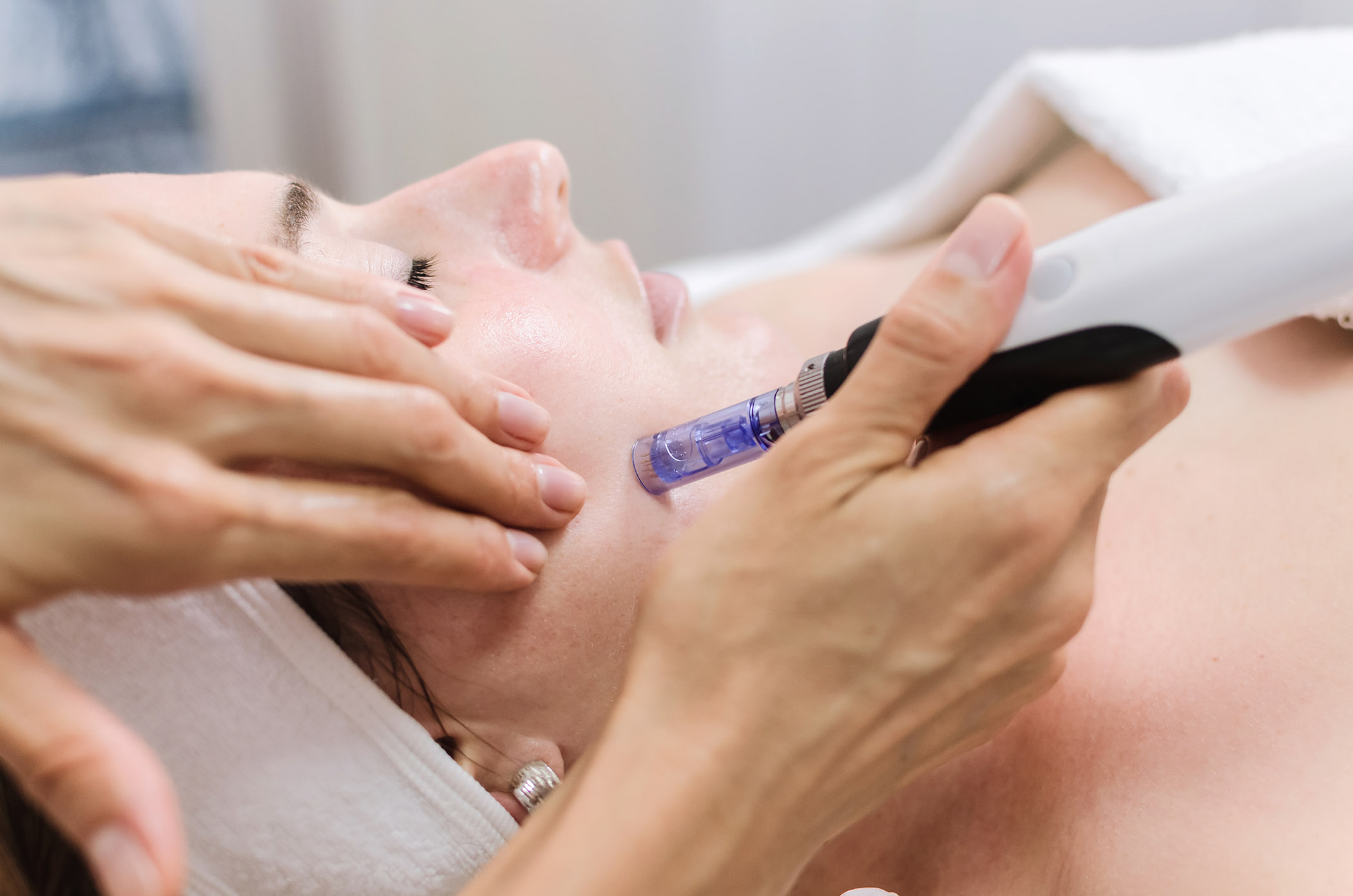 Micro Needling In Sydney CBD