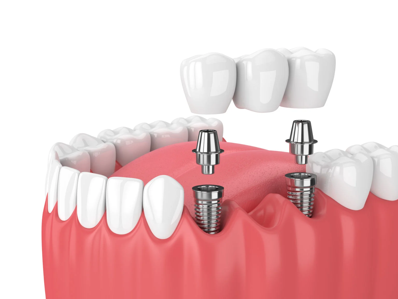 affordable dental implants sydney