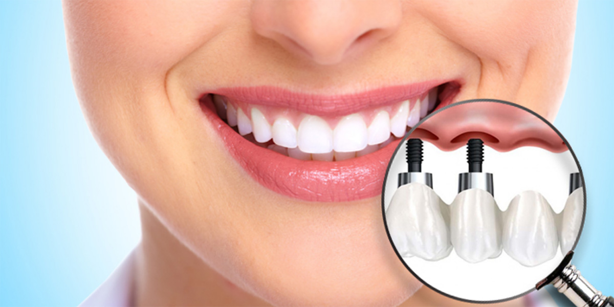 Dental Implants