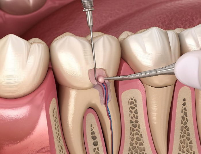 root canal Northcote